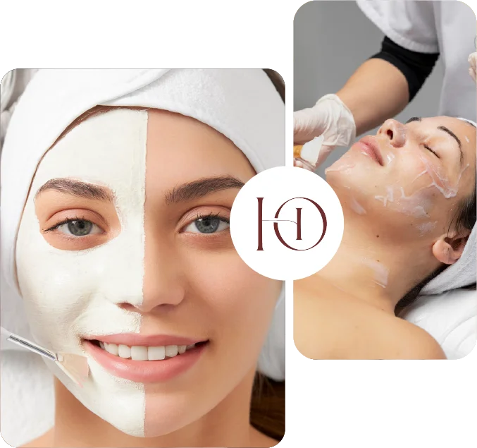 Peeling Químico Helen Dermoestética